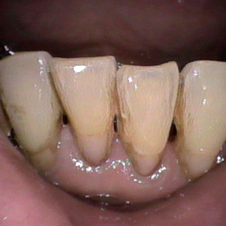 歯間のクリーニング