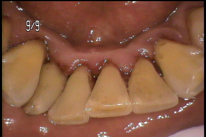 歯のクリーニング（歯石除去）
