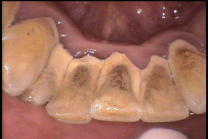 歯のクリーニング（歯石除去）