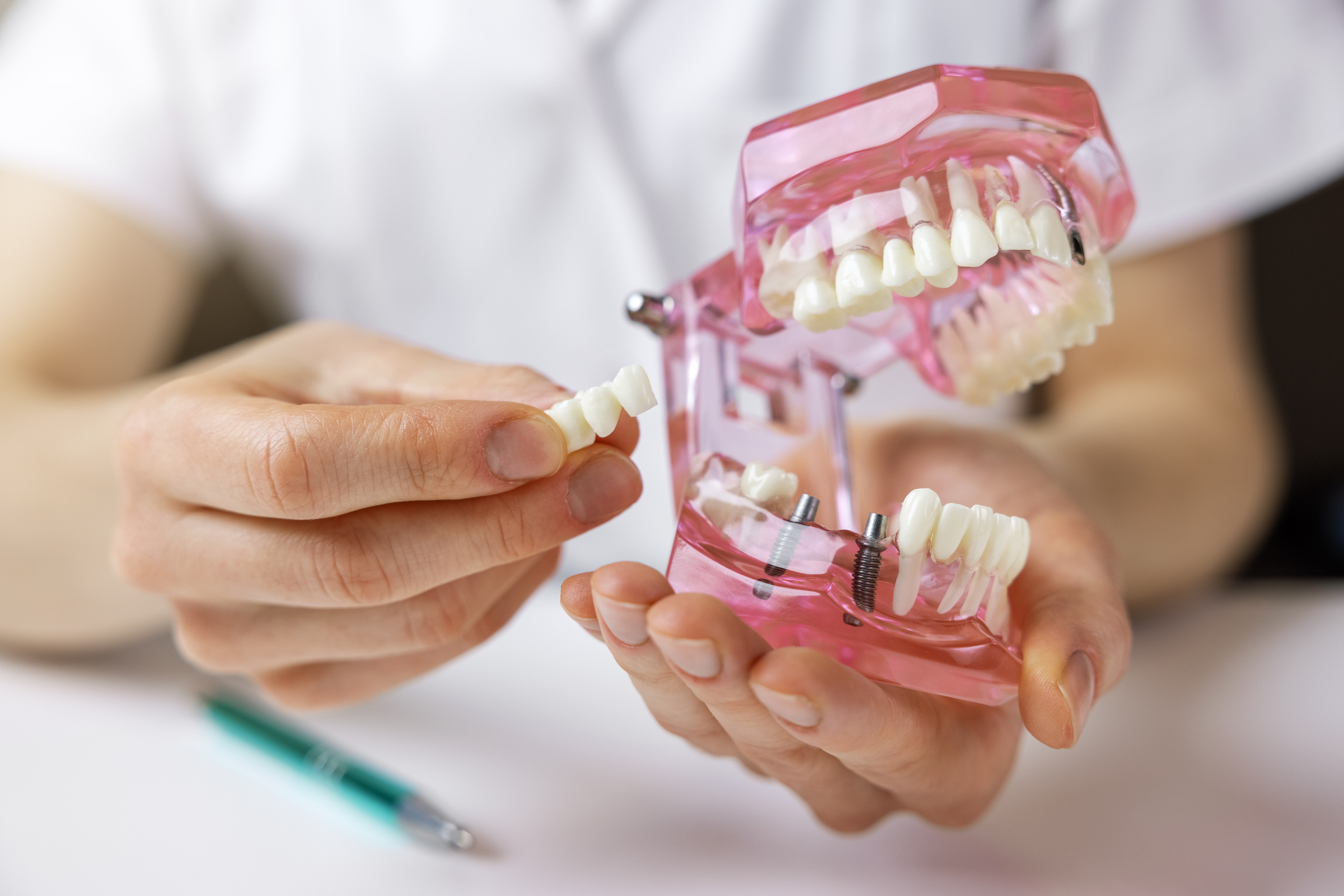 インプラント治療で歯がない期間の対応と注意点を解説！
