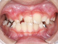 矯正　症例　前歯のワイヤー矯正