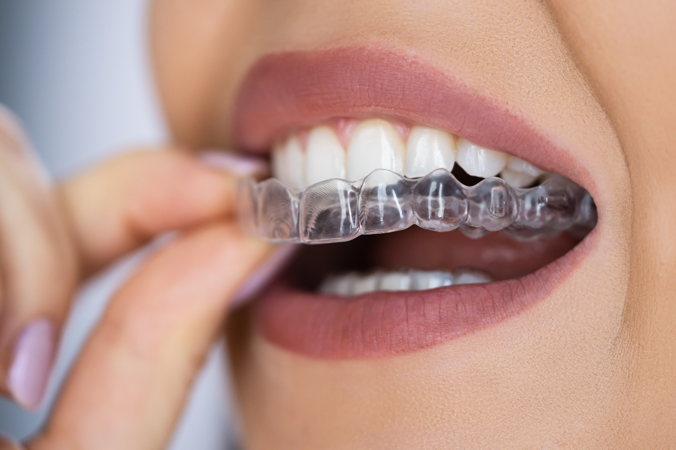 インビザラインでは前歯だけ治療できる？治療できる前歯の症例とは？