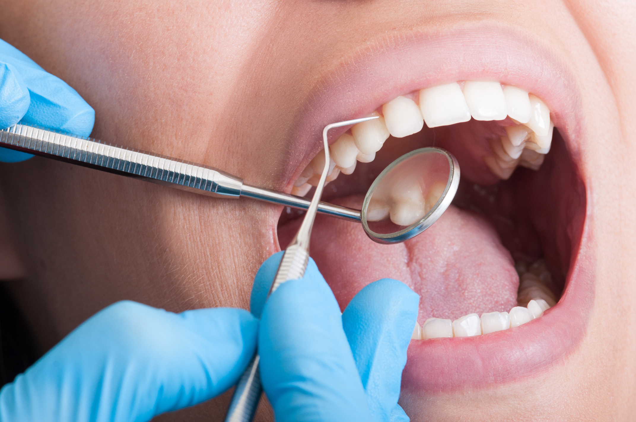 インビザライン矯正中の虫歯予防法と虫歯になったときの対処法を解説