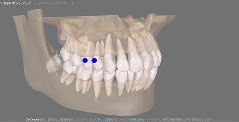 「Nemo」でより精度の高い矯正治療を実現