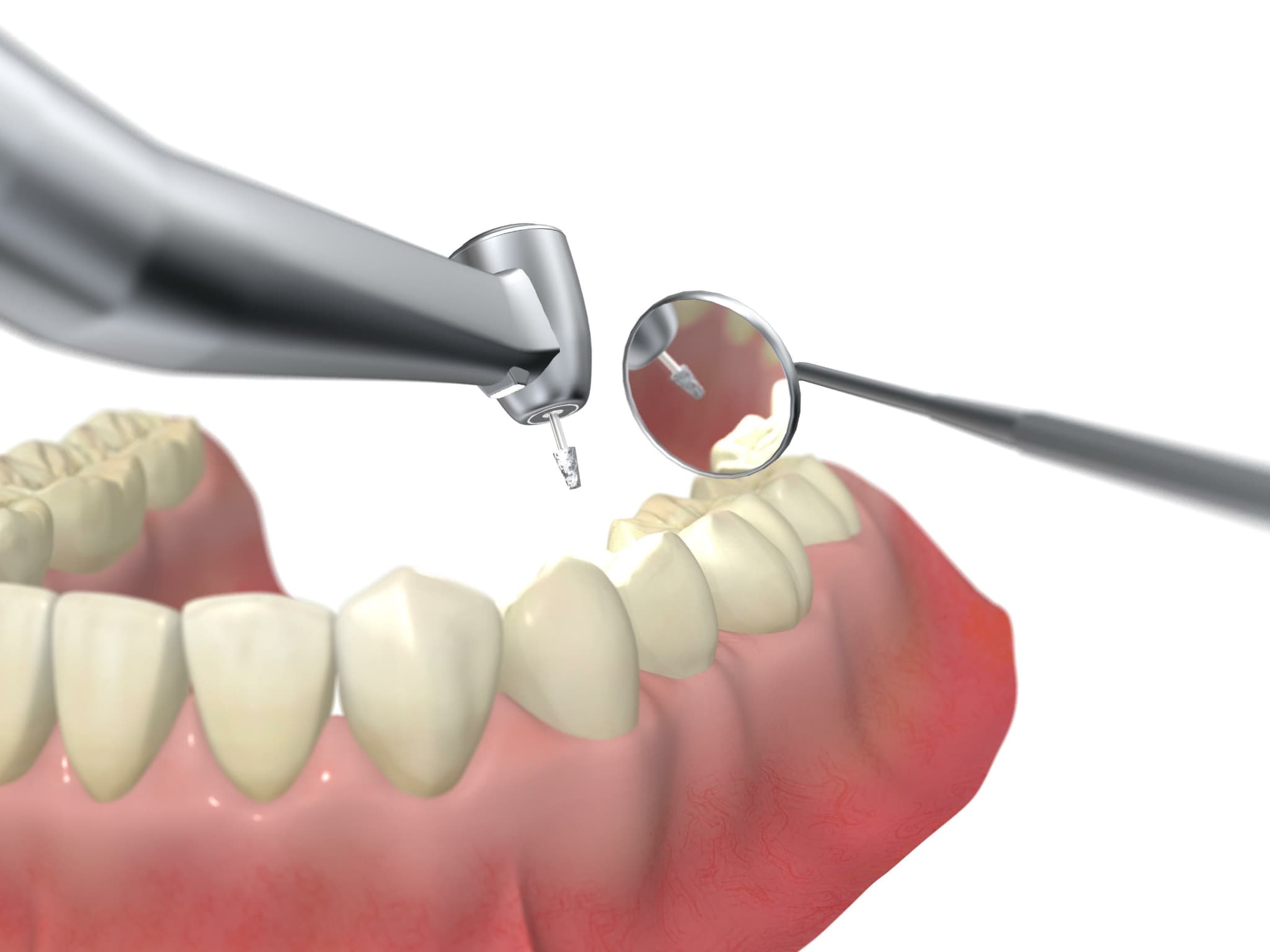 奥歯の虫歯の治療イメージ