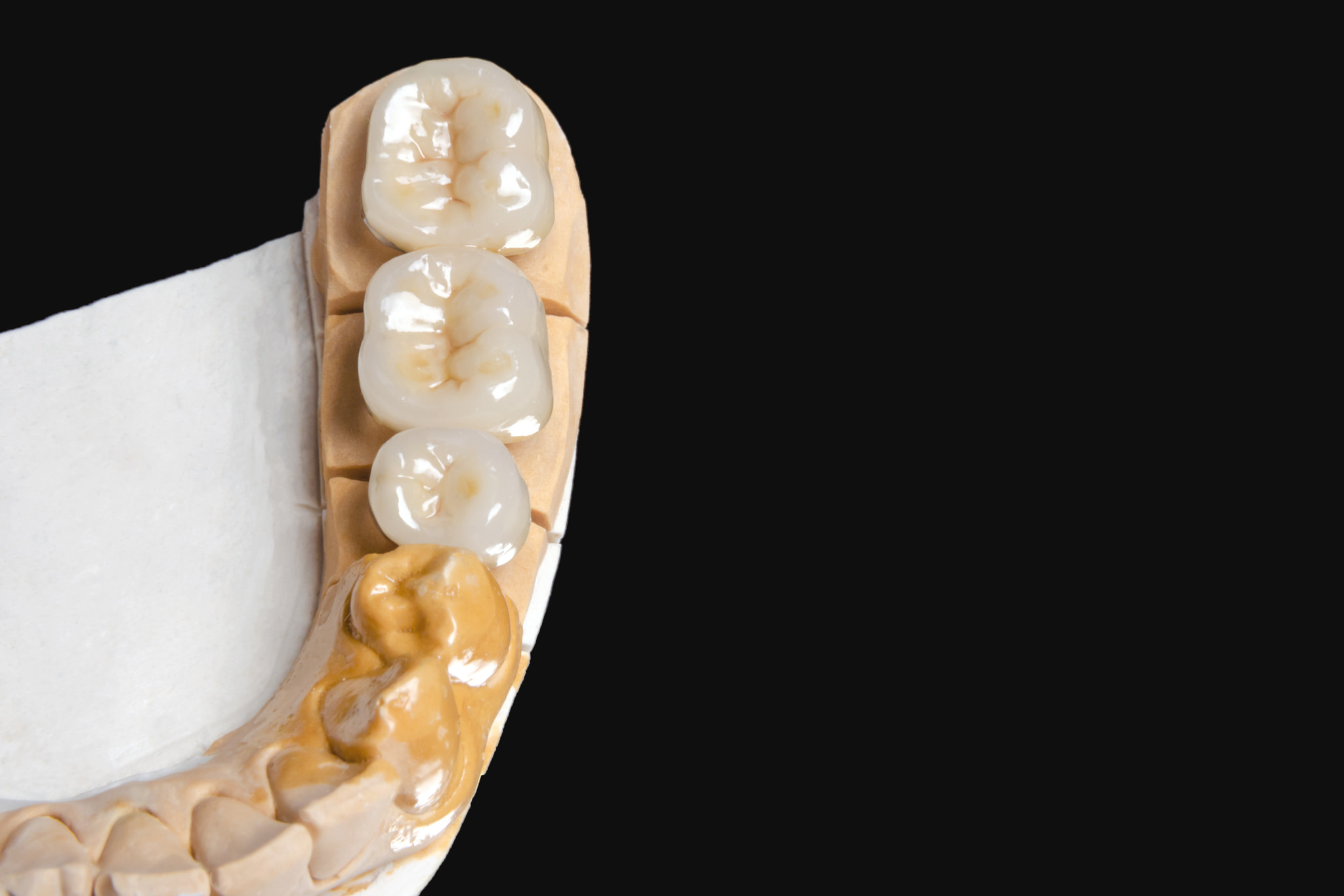 奥歯をセラミックで治療した模型