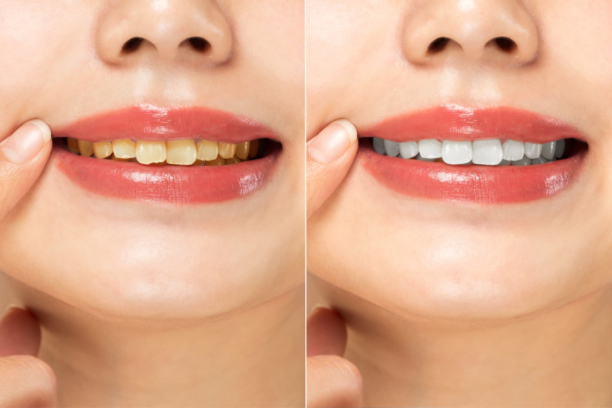 ホワイトニングをする前後のイメージ
