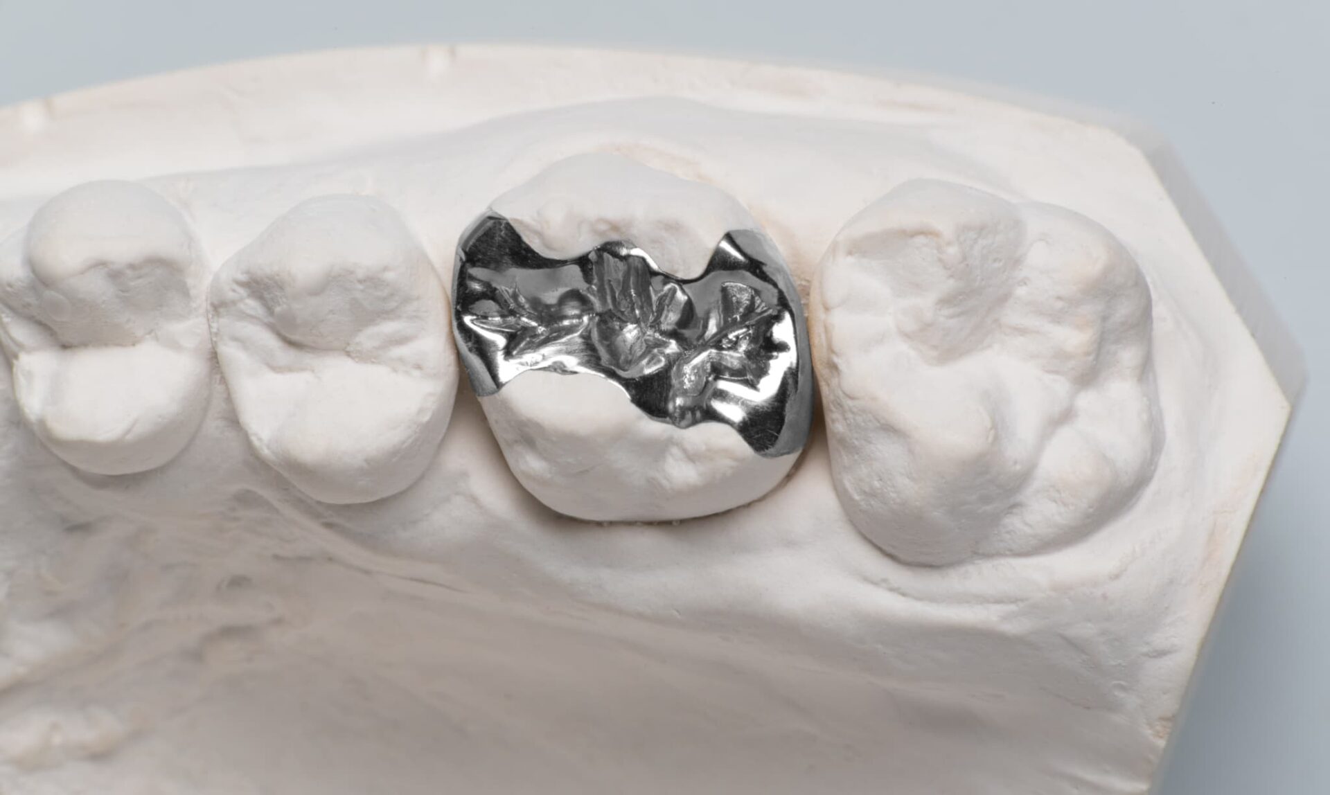 保険適用となる銀歯の詰め物