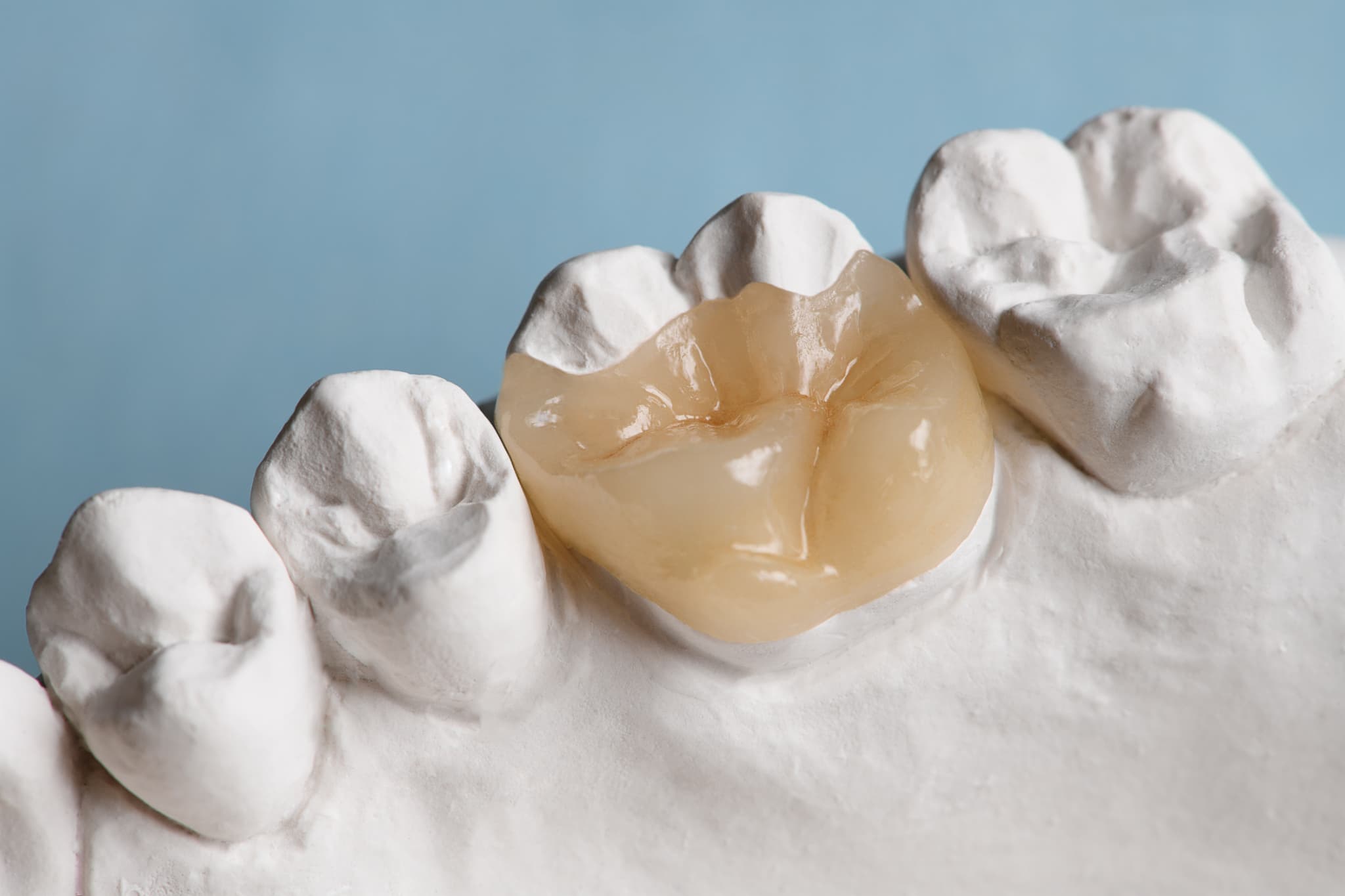 自費となるセラミックの歯の詰め物