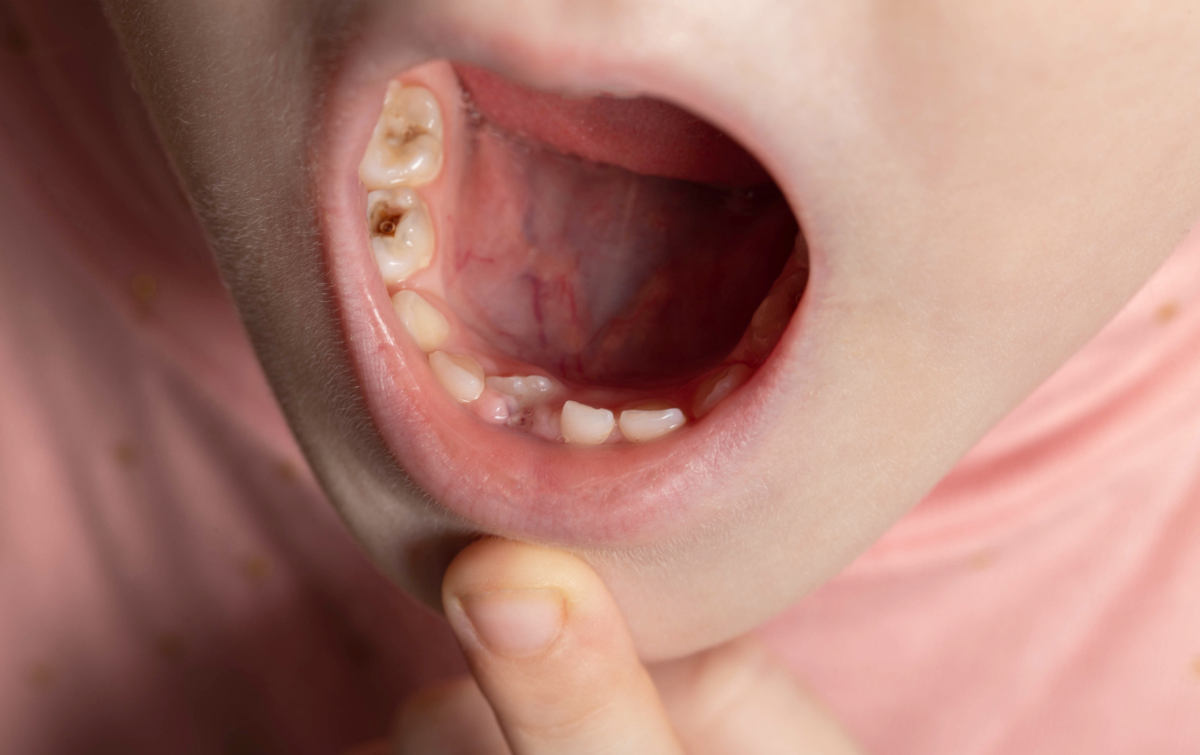 虫歯になってしまっている子ども